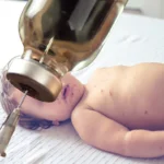 Muere niño por sarampión en Guerrero; su hermano gemelo dio positivo